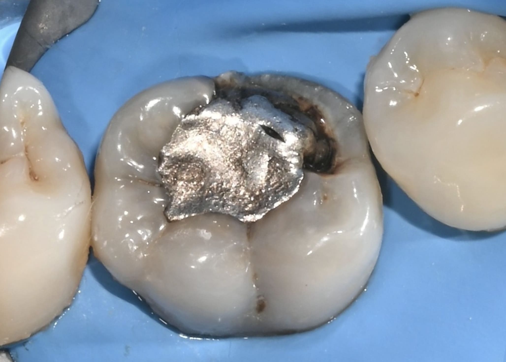 Avant restauration overlay – Dr Allain Nice