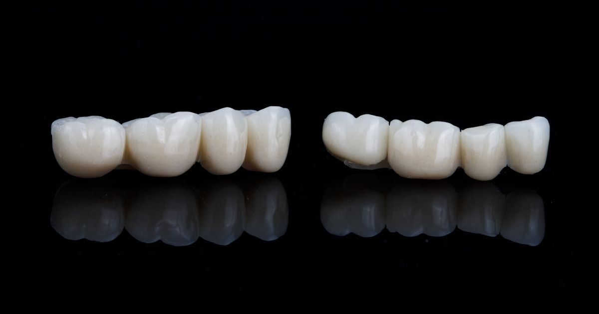 Bridge dentaire céramique – comparaison implant vs bridge – Dr Charbit Nice