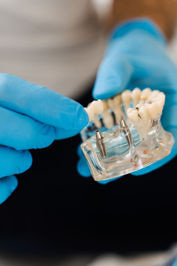 Implant dentaire sur mâchoire de démonstration - cabinet implantologie près de Saint-Laurent-du-Var