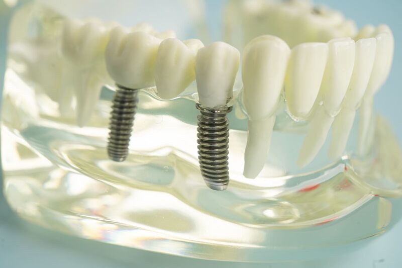 Modèle implant dentaire en titane - implantologue Nice Dr Charbit