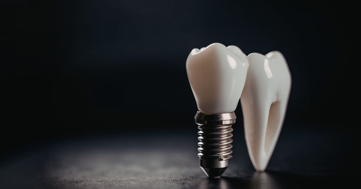 Modèle implant dentaire en titane – Dr Charbit Nice