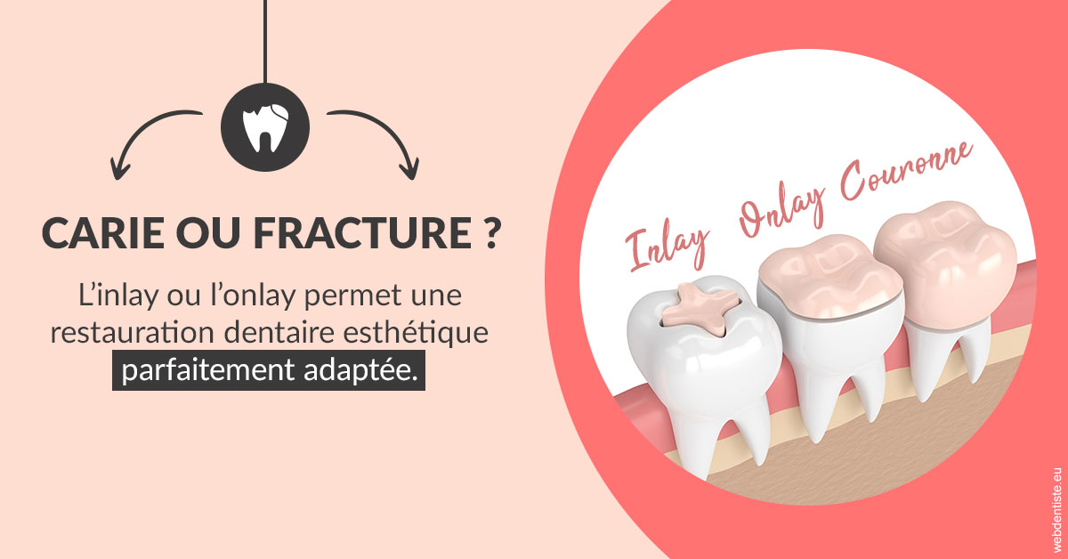 https://www.cabinet-dentaire-charbit.fr/T2 2023 - Carie ou fracture 2