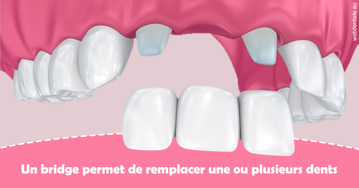 https://www.cabinet-dentaire-charbit.fr/Bridge remplacer dents 2