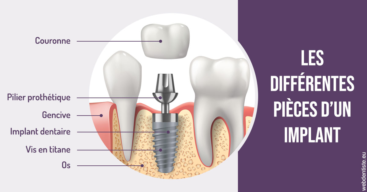 https://www.cabinet-dentaire-charbit.fr/Les différentes pièces d’un implant 2