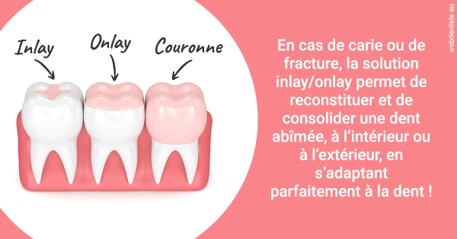 https://www.cabinet-dentaire-charbit.fr/L'INLAY ou l'ONLAY 2