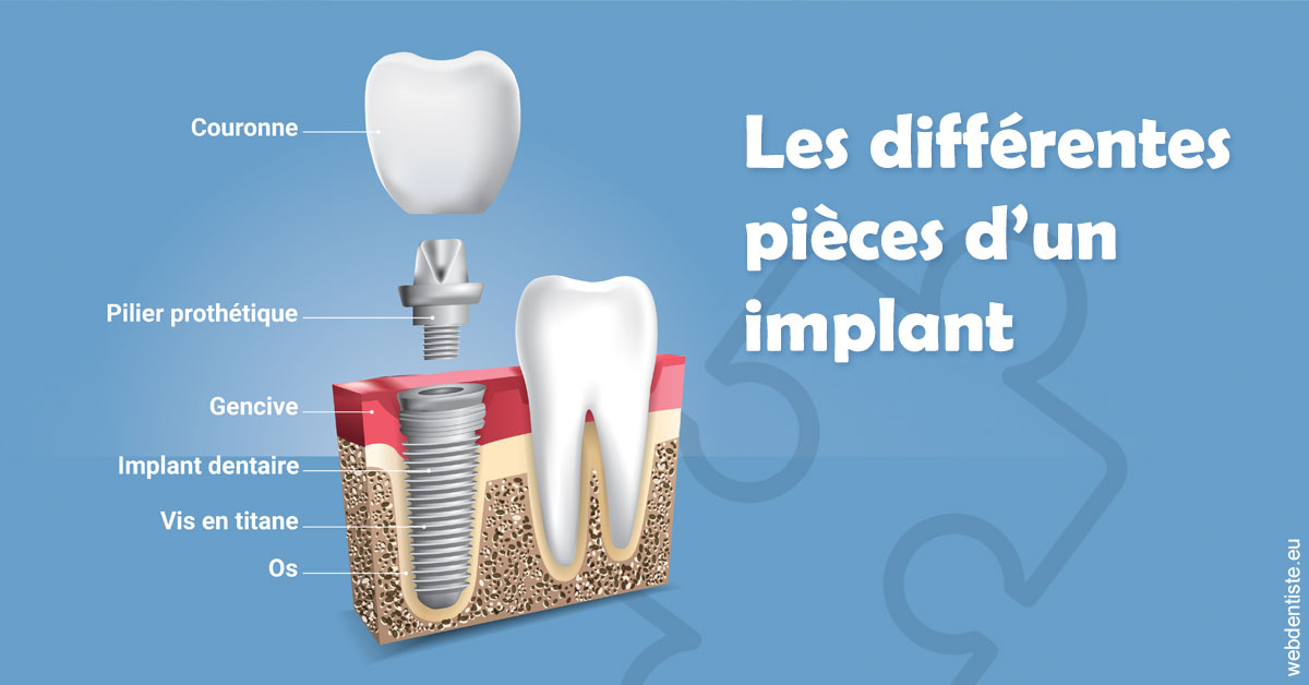 https://www.cabinet-dentaire-charbit.fr/Les différentes pièces d’un implant 1