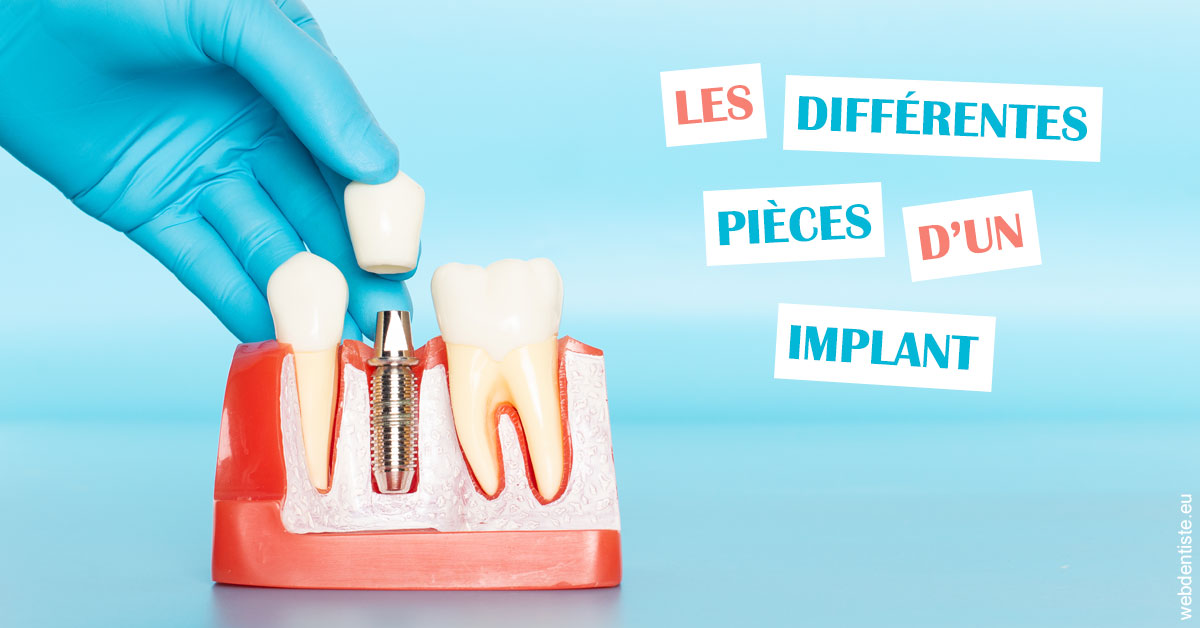 https://www.cabinet-dentaire-charbit.fr/Les différentes pièces d’un implant 2